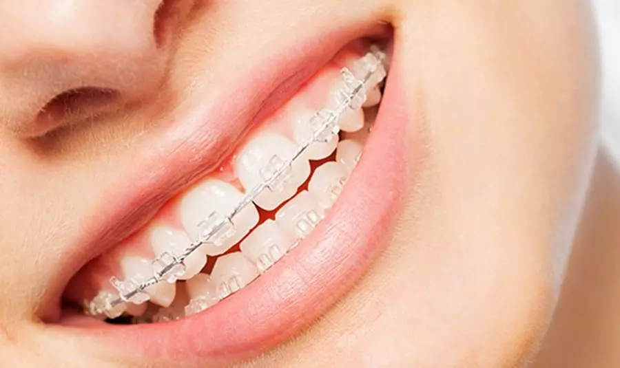 Ortodoncia con Brackets Estéticos Dental Aesthetic Center